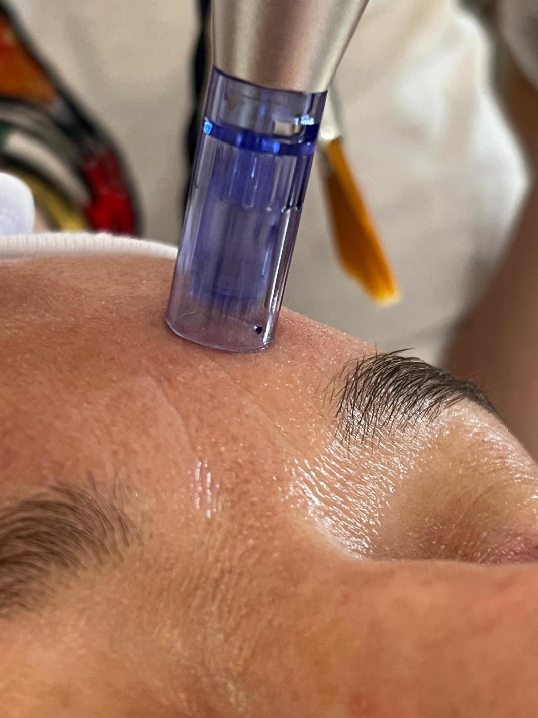 dermapen para fisioterapeutas