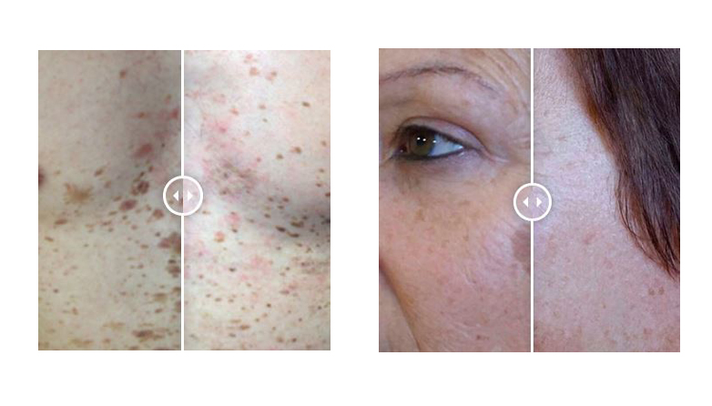 Tratamiento de manchas solares y seniles. Centro Tándem en Prosperidad, Madrid